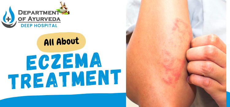 All about - Eczema Treatment